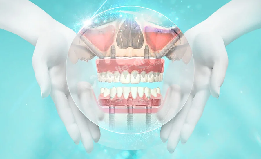 Что такое скуловая имплантация зубов