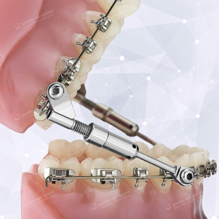 Ортодонтические функциональные аппараты