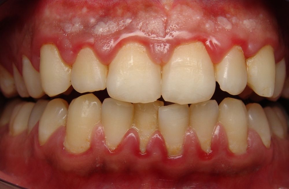 Зубной камень: почему появляется и как убрать