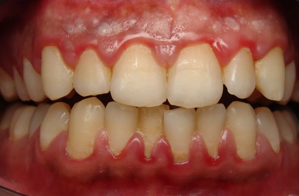 осложнения при зубном камне