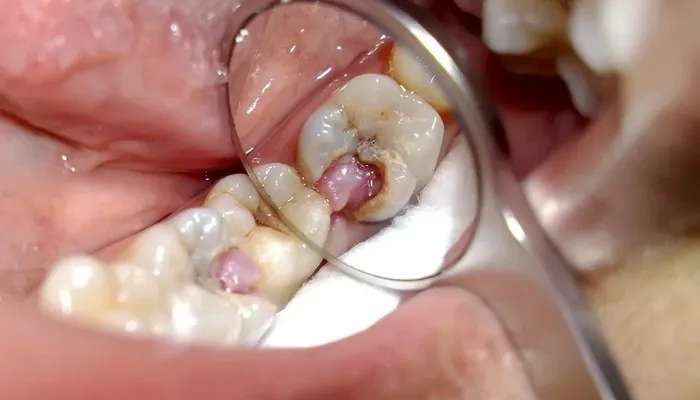 Фото: Осложнения пульпита зубов