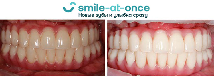 какую методику отбеливания выбрать