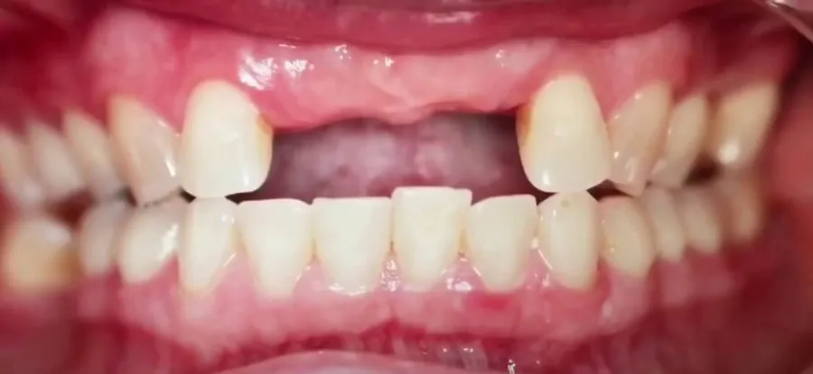 частичное отсутствие зубов
