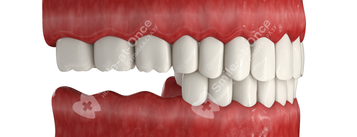 Отсутствие зубов
