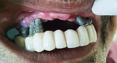 Отторжение зубных имплантов фото