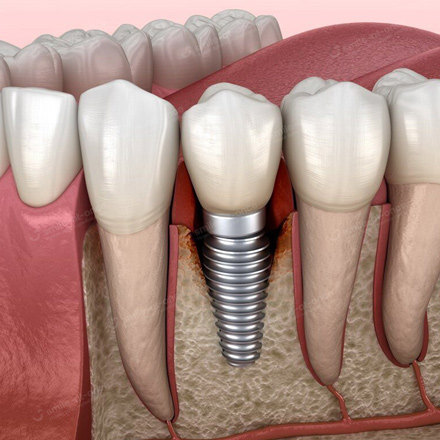 Осложнения и ошибки после имплантации зубов