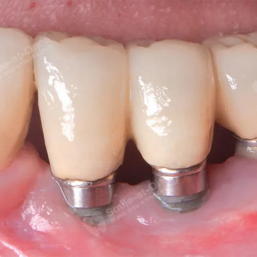 Боль после имплантации зубов