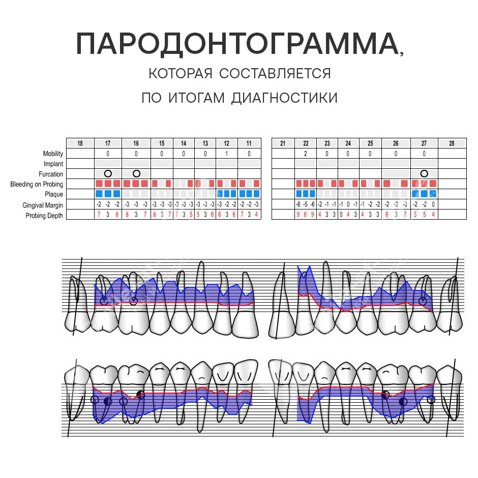 Пародонтограмма