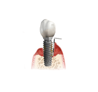 Отторжение зубных имплантов или периимплантит