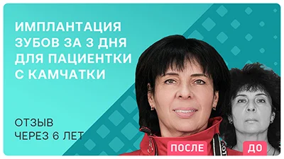 Видео - Подробный отзыв о результатах имплантации и моментального протезирования