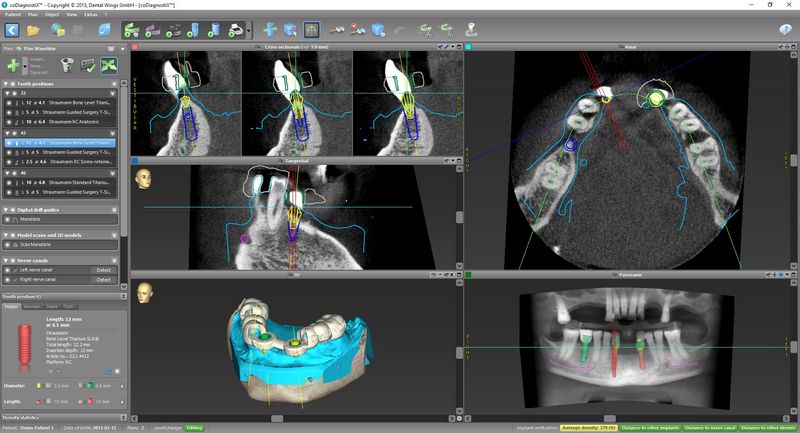 Моделирование имплантации зубов