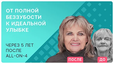 Видео - Через 5 лет после all-on-4 – отзыв реального пациента