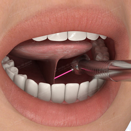Подрезание уздечки верхней, нижней губы и языка
