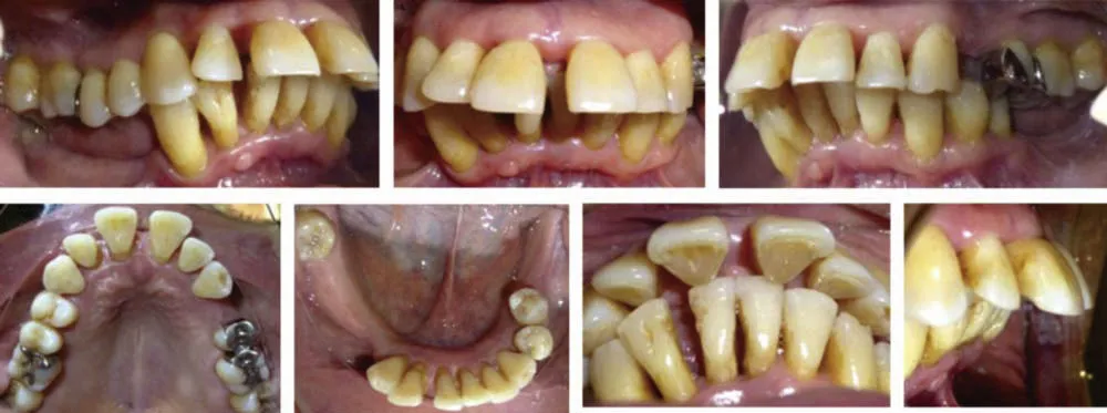 Подвижность зубов как следствие пародонтита