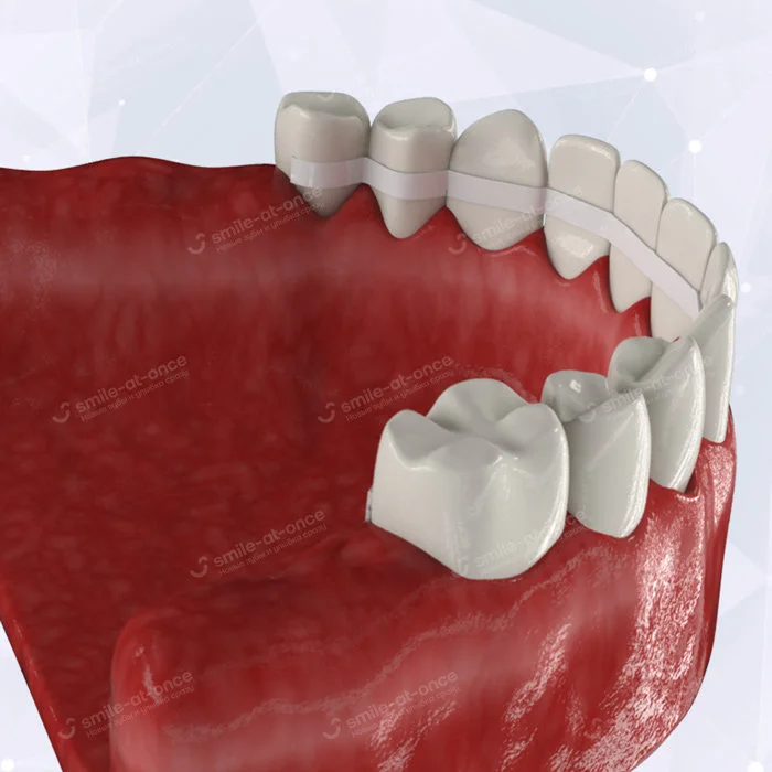 Шинирование зубов поможет избавиться от их подвижности