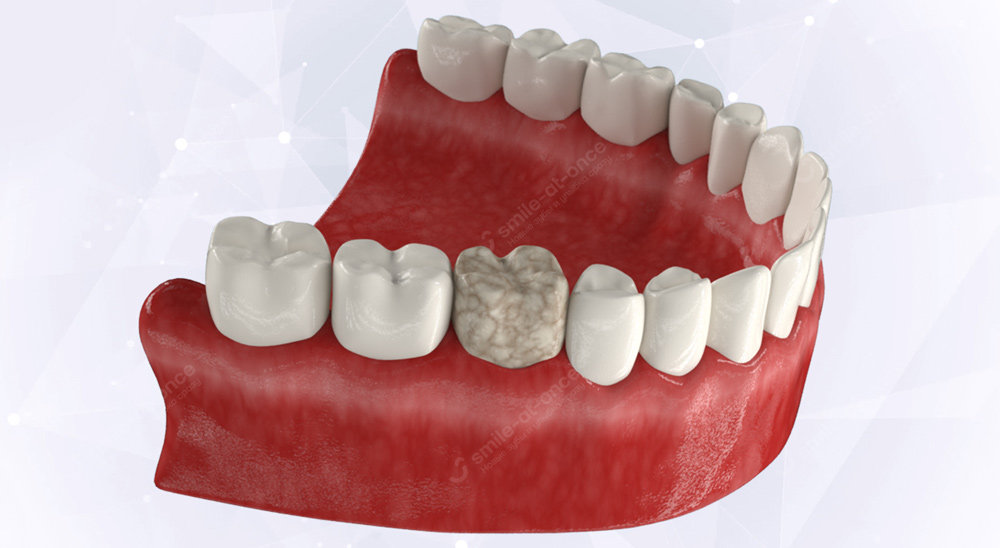 Причины возникновения боли после стоматологического вмешательства: