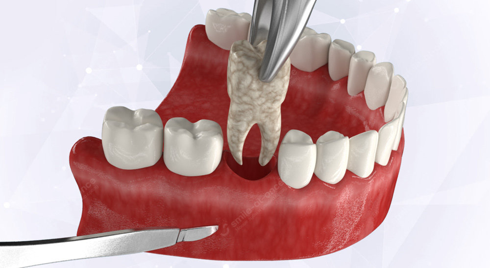 Что происходит с костью после удаления зуба
