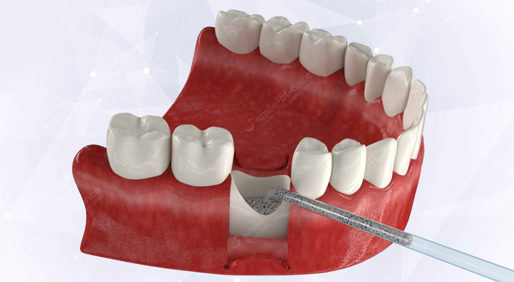 Что происходит с костью после удаления зуба