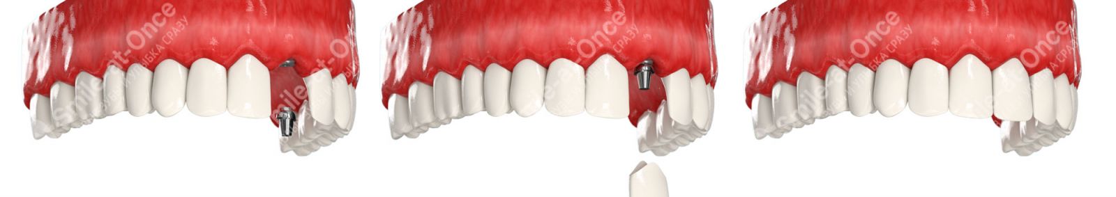 Имплант при отсутствии одного зубы