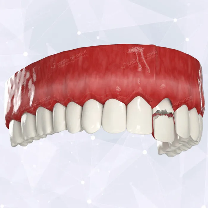 Пример потери переднего зуба