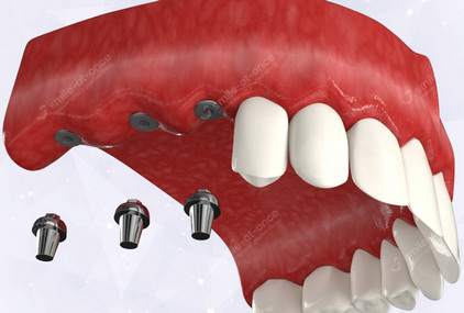 Несъемные протезы при отсутствии нескольких зубов