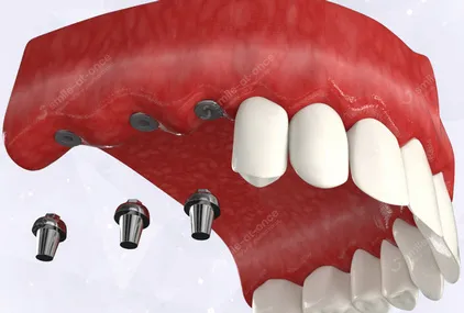 Несъемные протезы при отсутствии нескольких зубов - установка имплантов