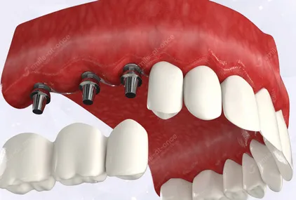 Несъемные протезы при отсутствии нескольких зубов - установка протезов