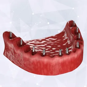 Несъемные протезы при отсутствии всех зубов - установка имплантов