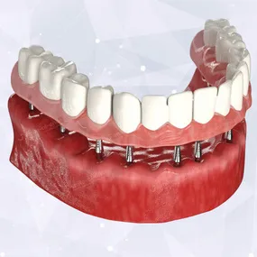 Несъемные протезы при отсутствии всех зубов - установка зубного протеза