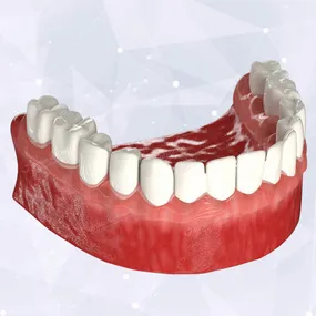 Несъемные протезы при отсутствии всех зубов - зубной протез установлен