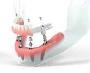 Имплантация зубов Pro Arch