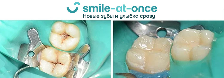 до и после кариеса жевательных зубов