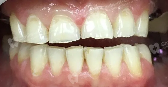 сколы трещины зубов