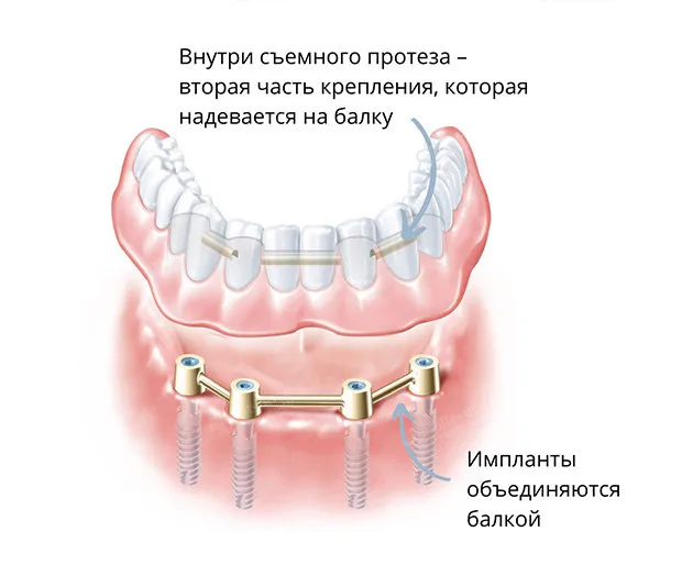 Зубные протезы на балке