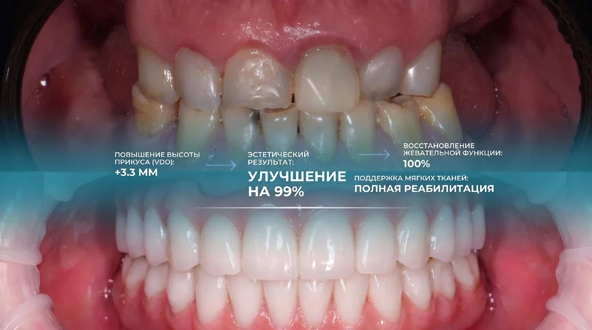 Результат проведенной имплантации зубов