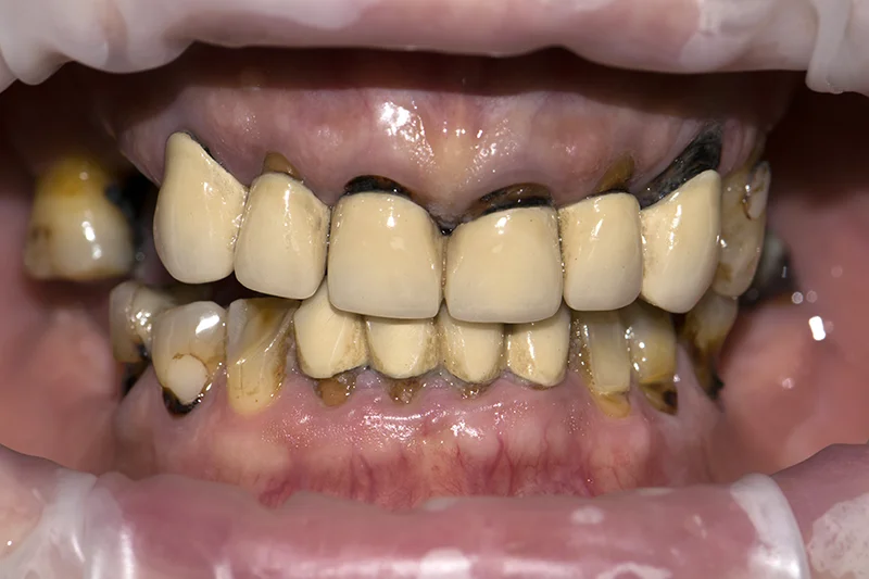 фото до комплексной имплантации зубов