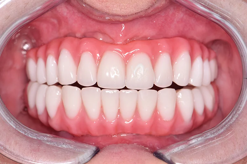 фото после комплексной имплантации зубов