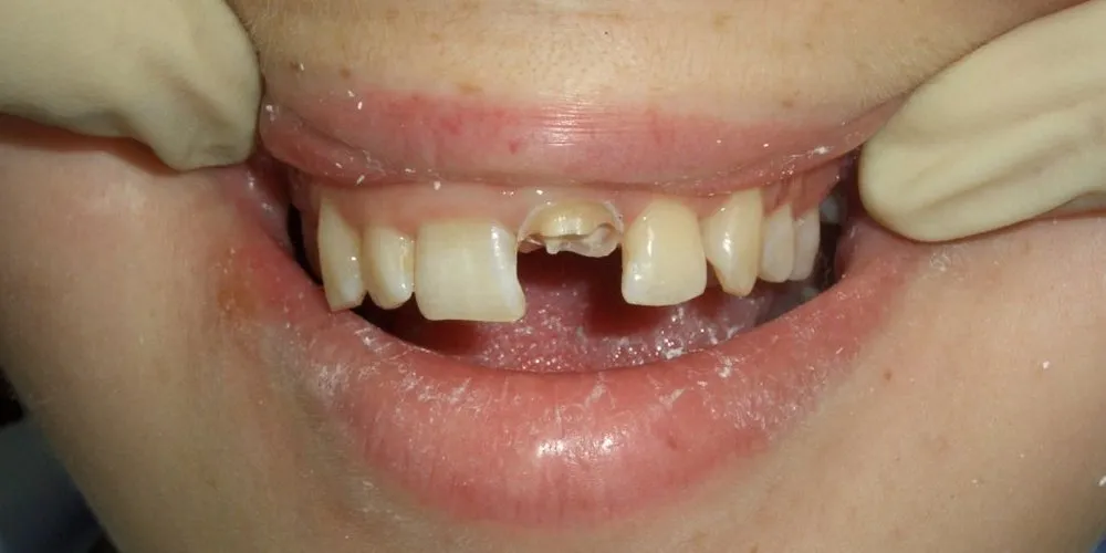 Пример разрушенного зуба