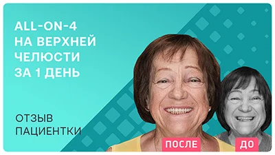 Видео - Восстановление всех зубов на верхней челюсти за 1 день
