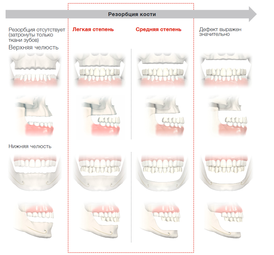 Показания к восстановлению зубов