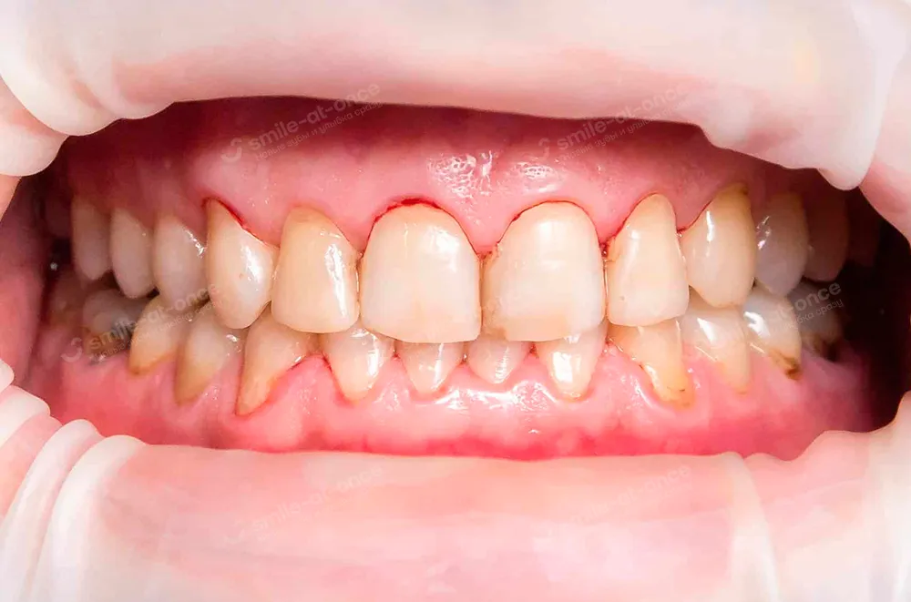 Симптомы проявления флюороза на зубах
