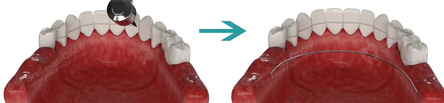 Проведение шинирования зубов