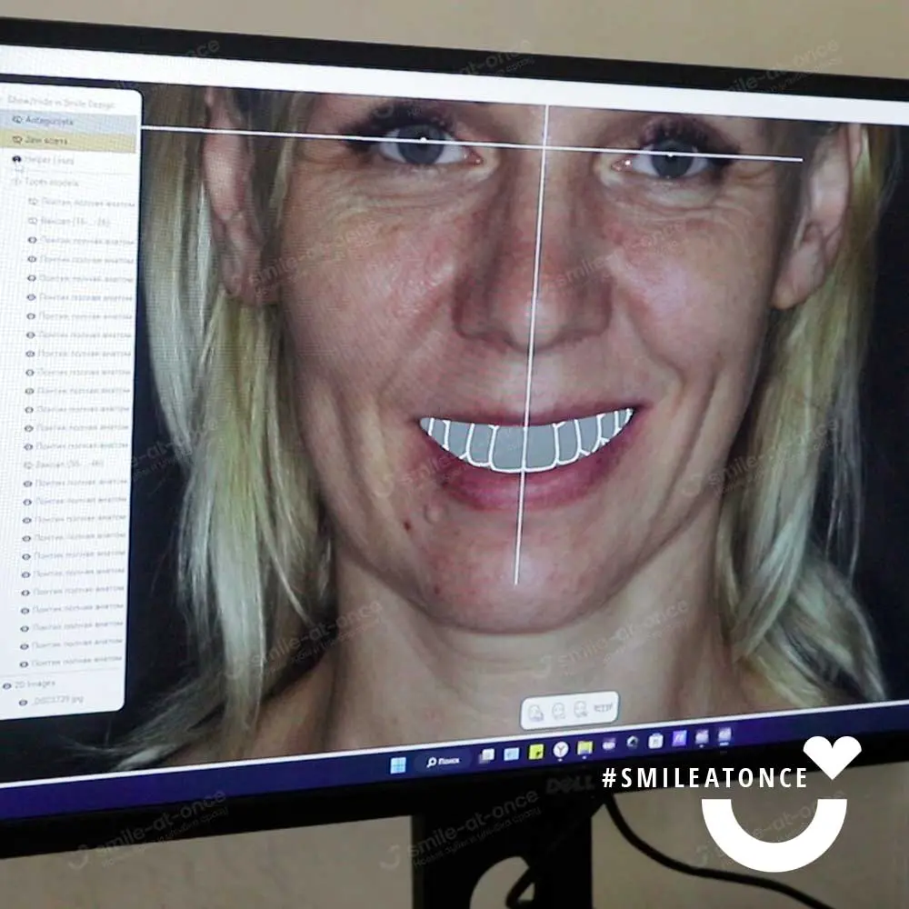 Ольга во время моделирования будущей улыбки