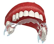 Съемное протезирование жевательных зубов