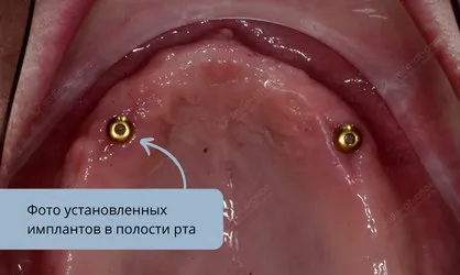 Фото имплантов в полости рта