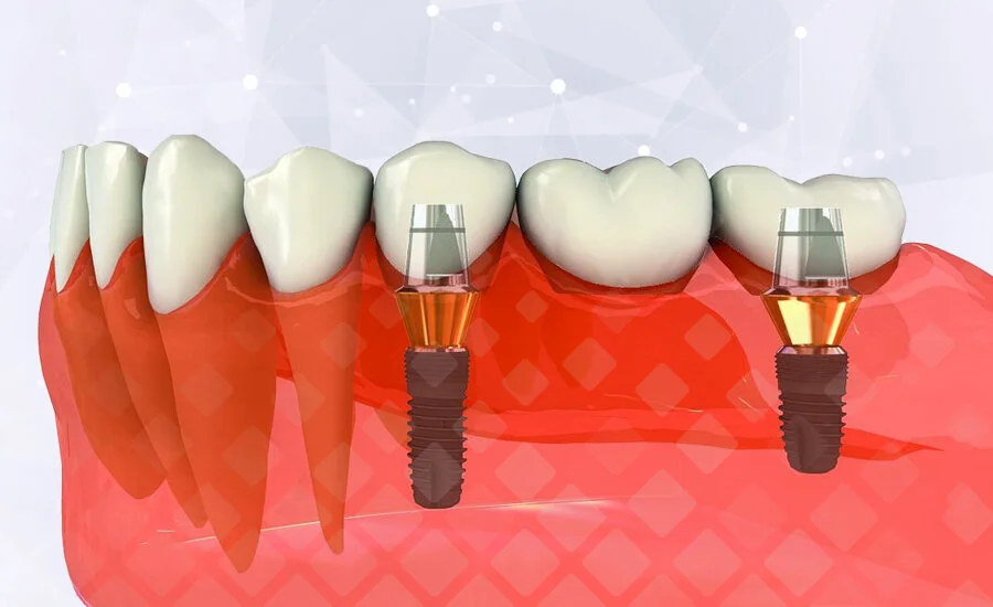 Установка классических имплантов зубов