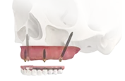 Скуловая имплантация зубов для верхней челюсти