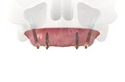 Скуловая имплантация зубов