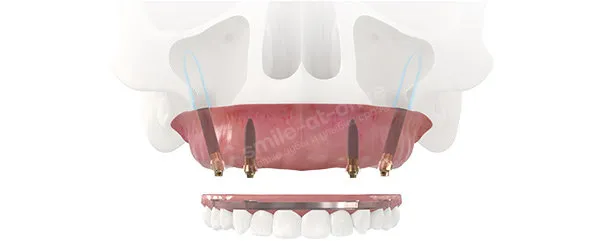 Имплантация зубов при атрофии без костной пластики