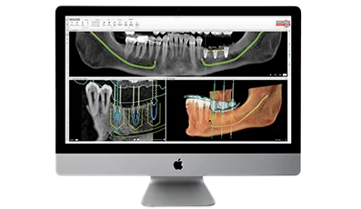 3D-планирование и проработка лечения